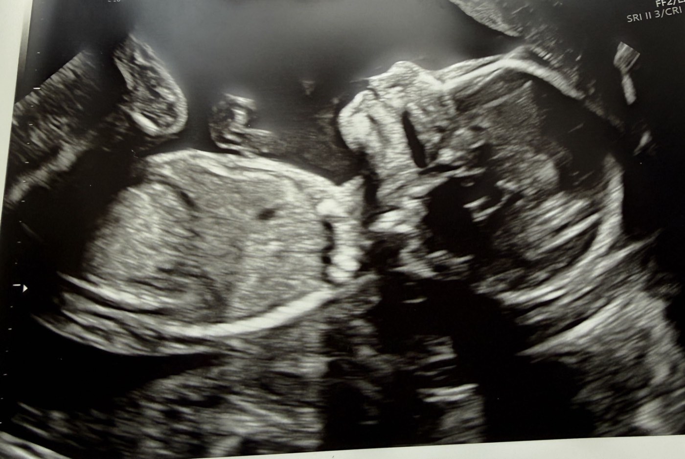 Close-up ultrasound scan